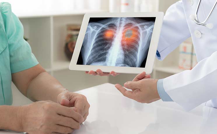 lung cancer concept. doctor explaining results of lung check up from x-ray scan chest on digital tablet screen to patient.